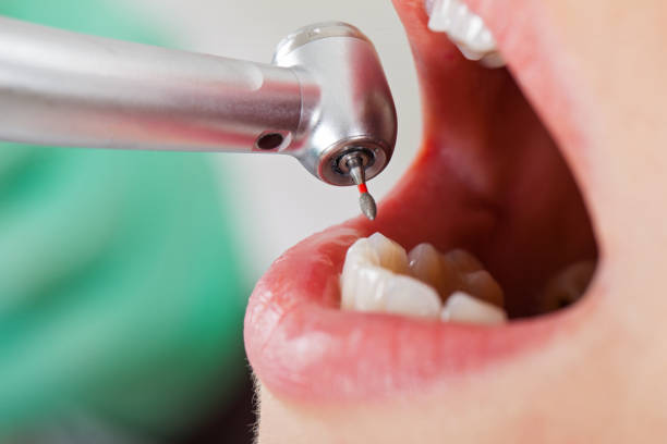 Best Emergency Root Canal Treatment in Timpson, TX